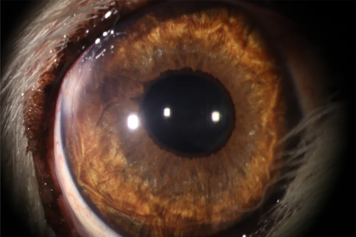 백내장 치료 후