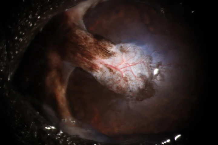 각막 천공 결막이식술 치료 후