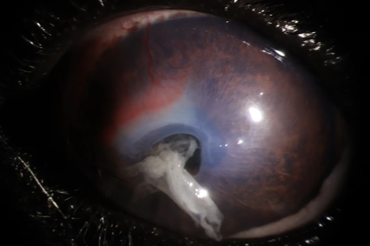 각막 천공 결막이식술 치료 전