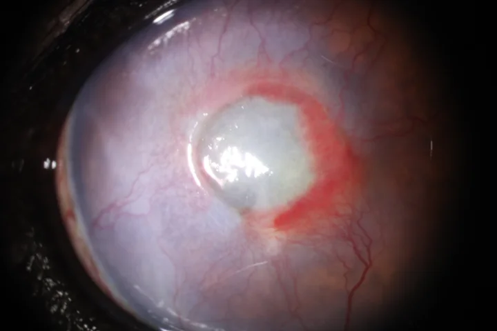 녹내장 - 모양체파괴주사 치료 전