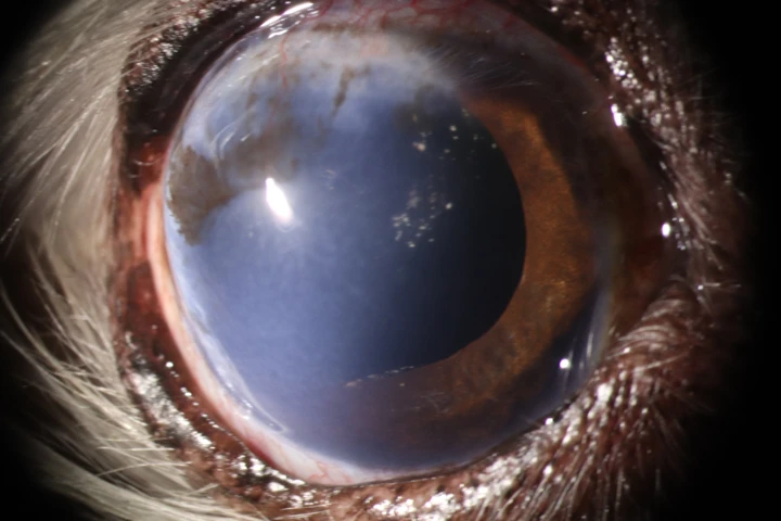 수정체 탈구 치료 후