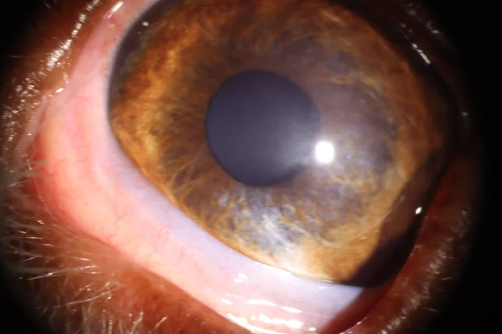 난치성 각막 궤양 치료 후